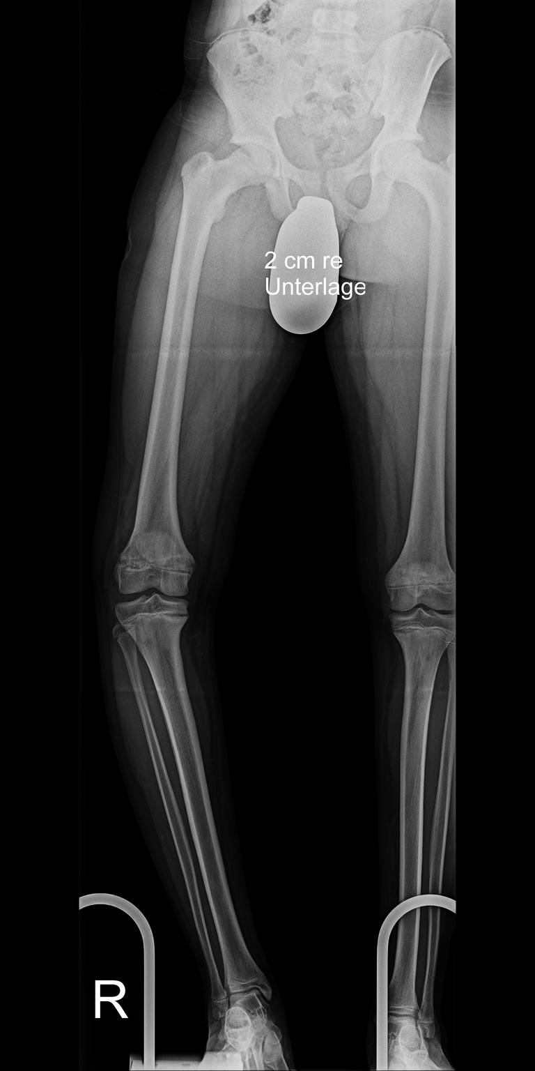 LSR before treatment