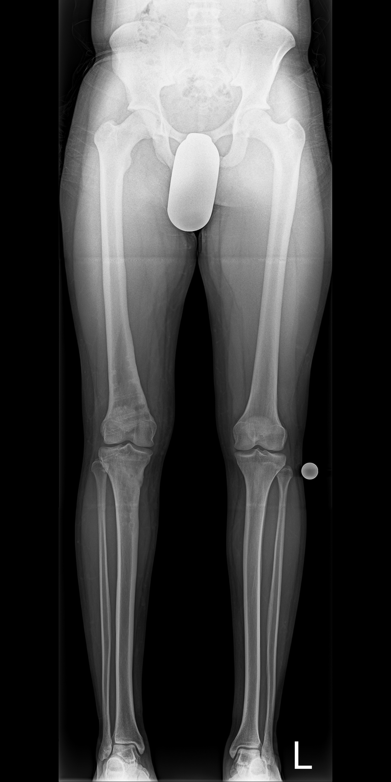 A straight right leg after surgical upper and lower leg corrections