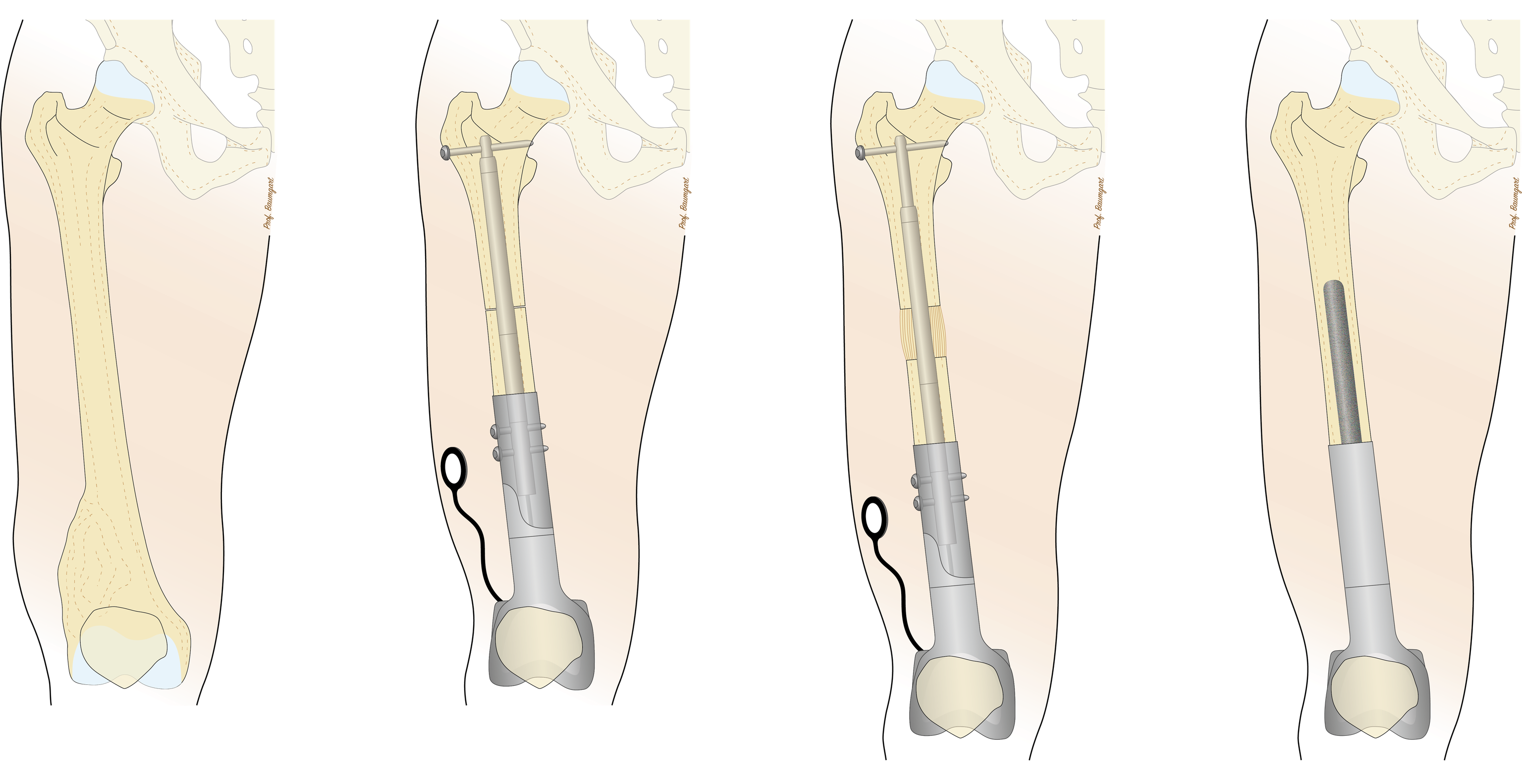 BioXpand femur