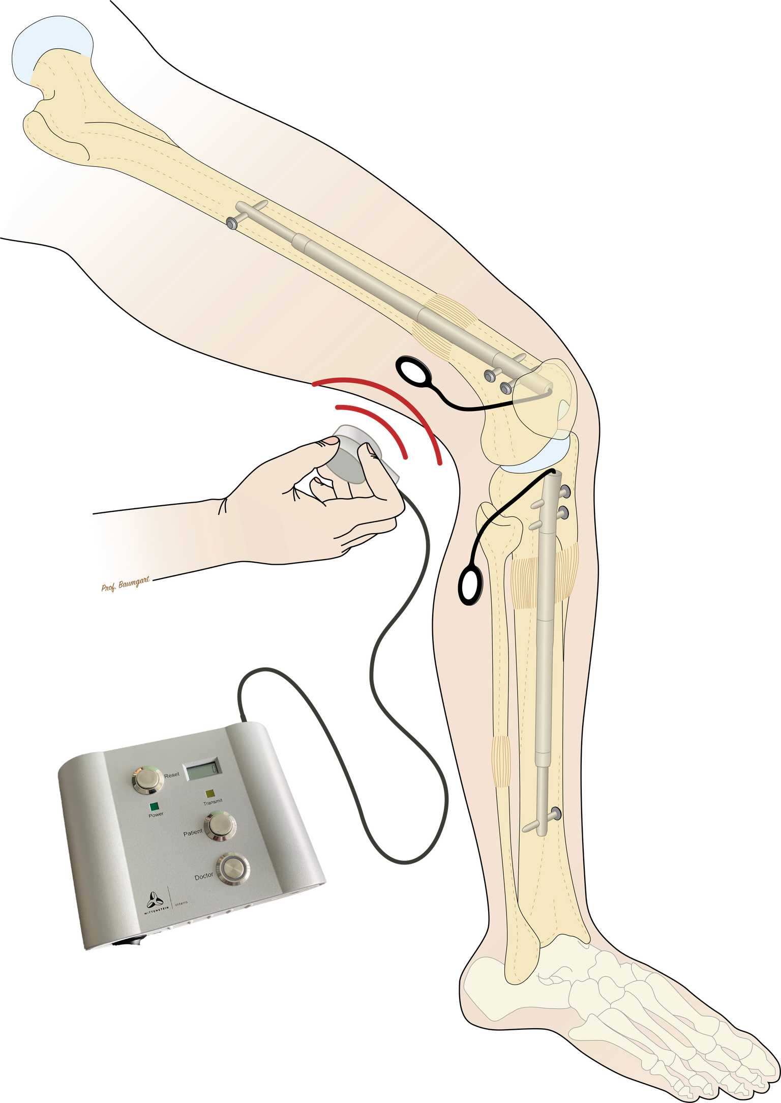 FITBONE-System