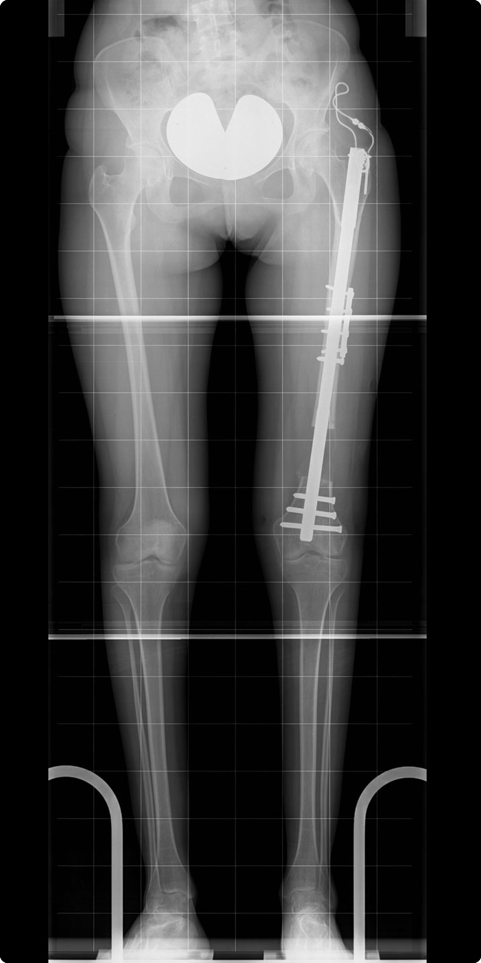 FITBONE-Distraktionsmarknagel