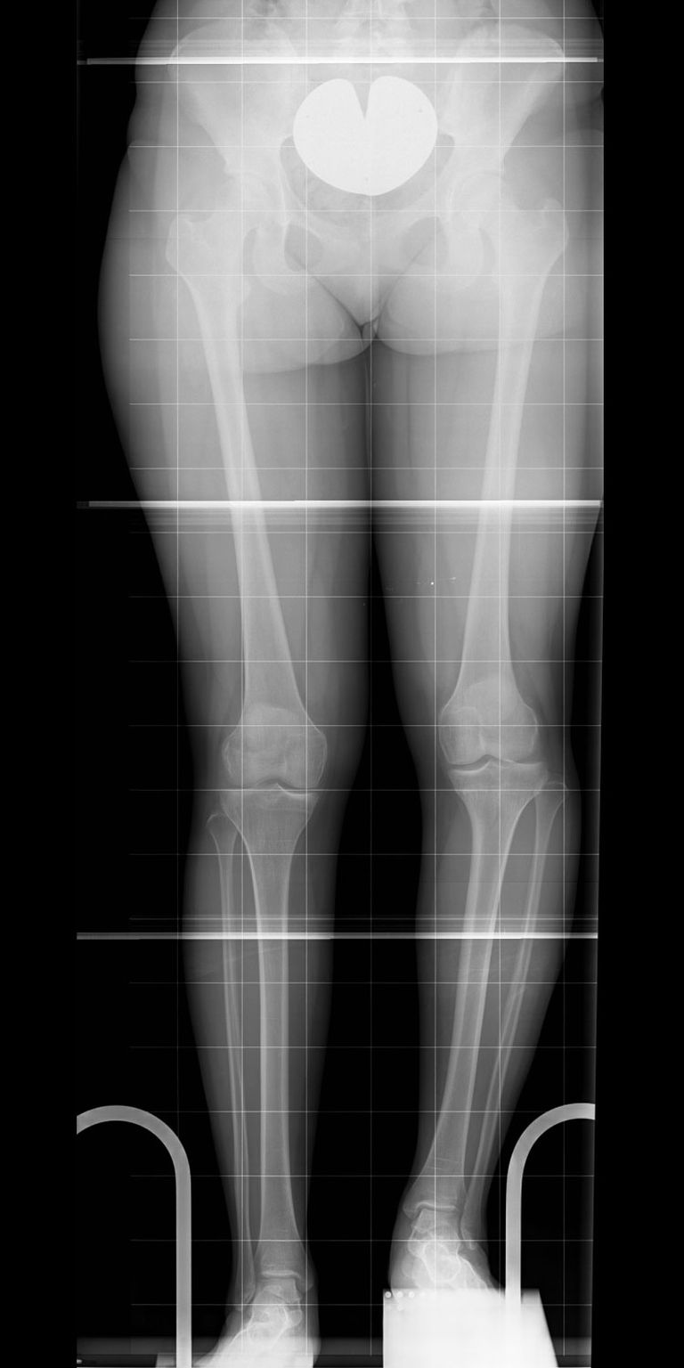 Shortening and clear deformity of the left leg