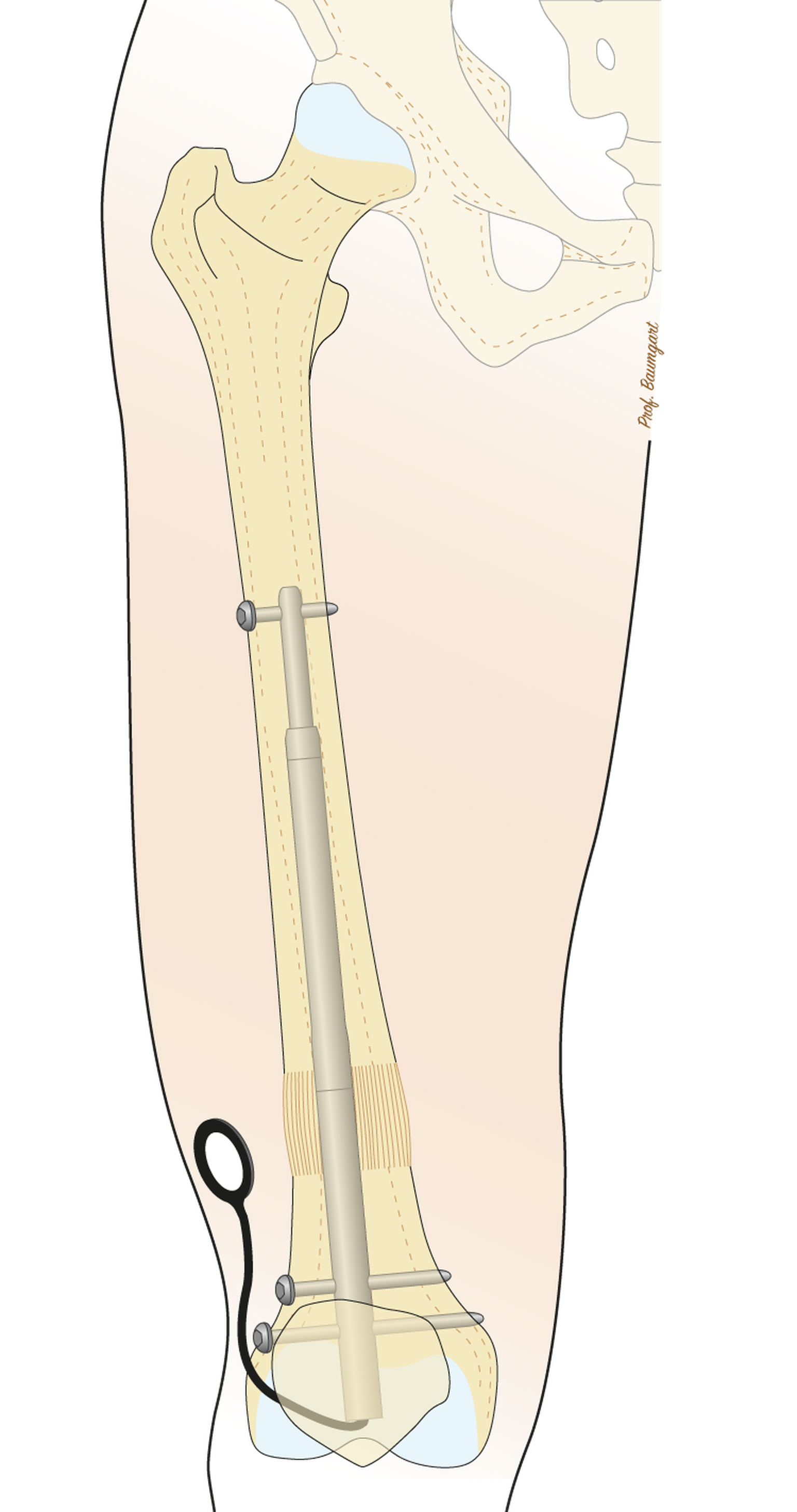 FITBONE в бедренной кости