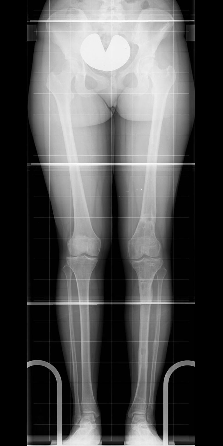 Straight legs of equal length