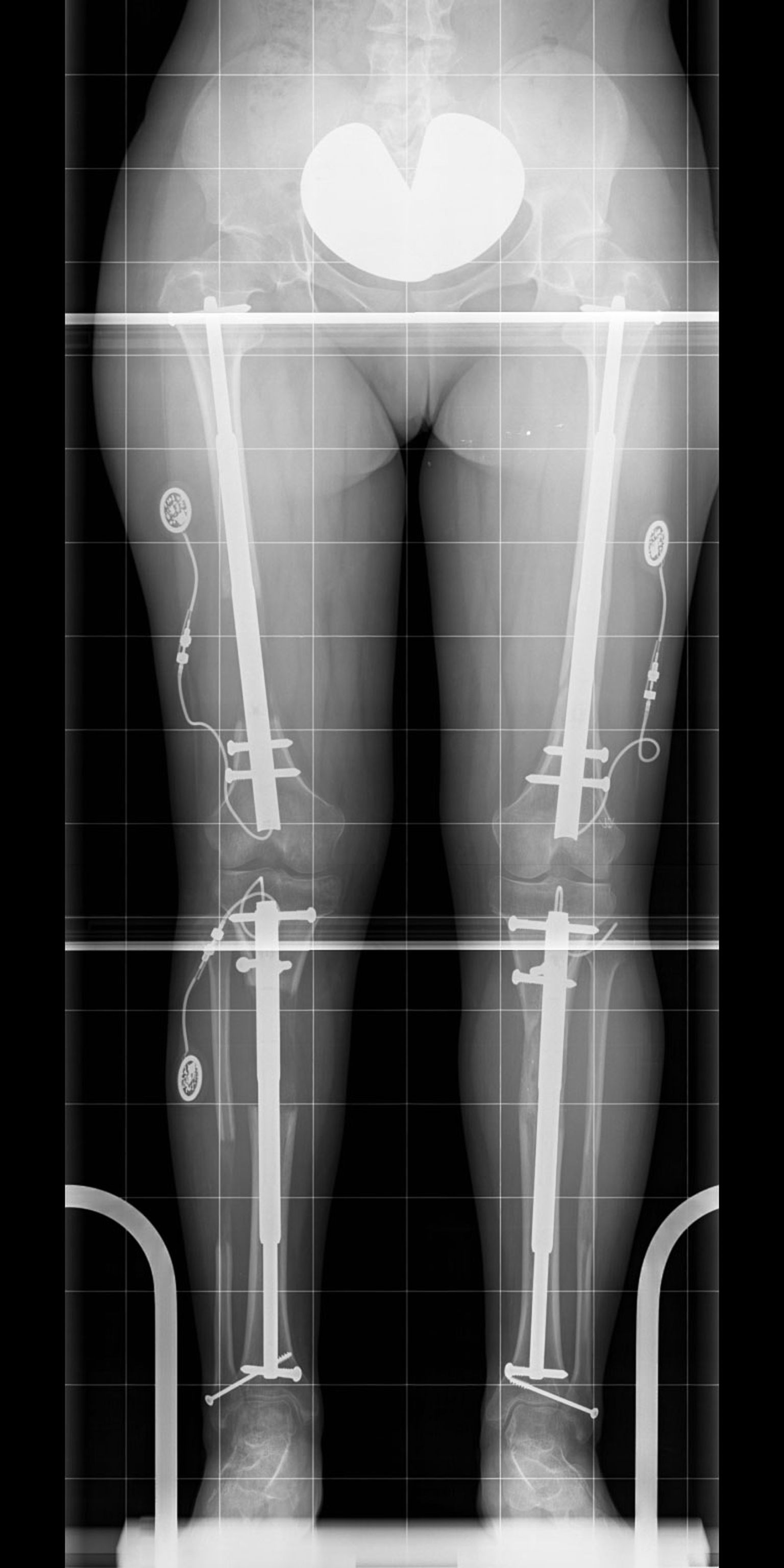Simultaneous upper (femur) and lower leg (tibia) lengthening