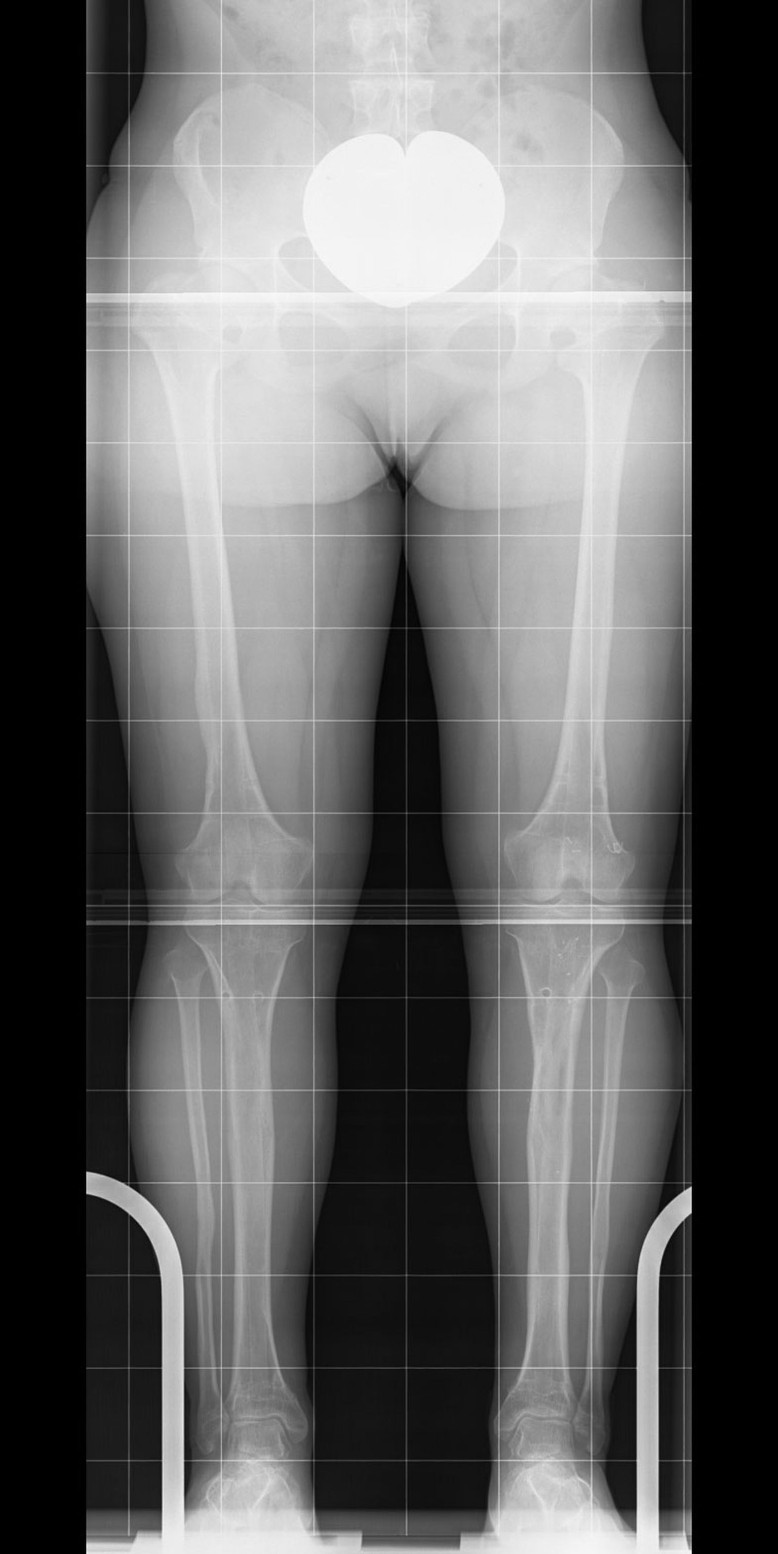 After completion of the treatment