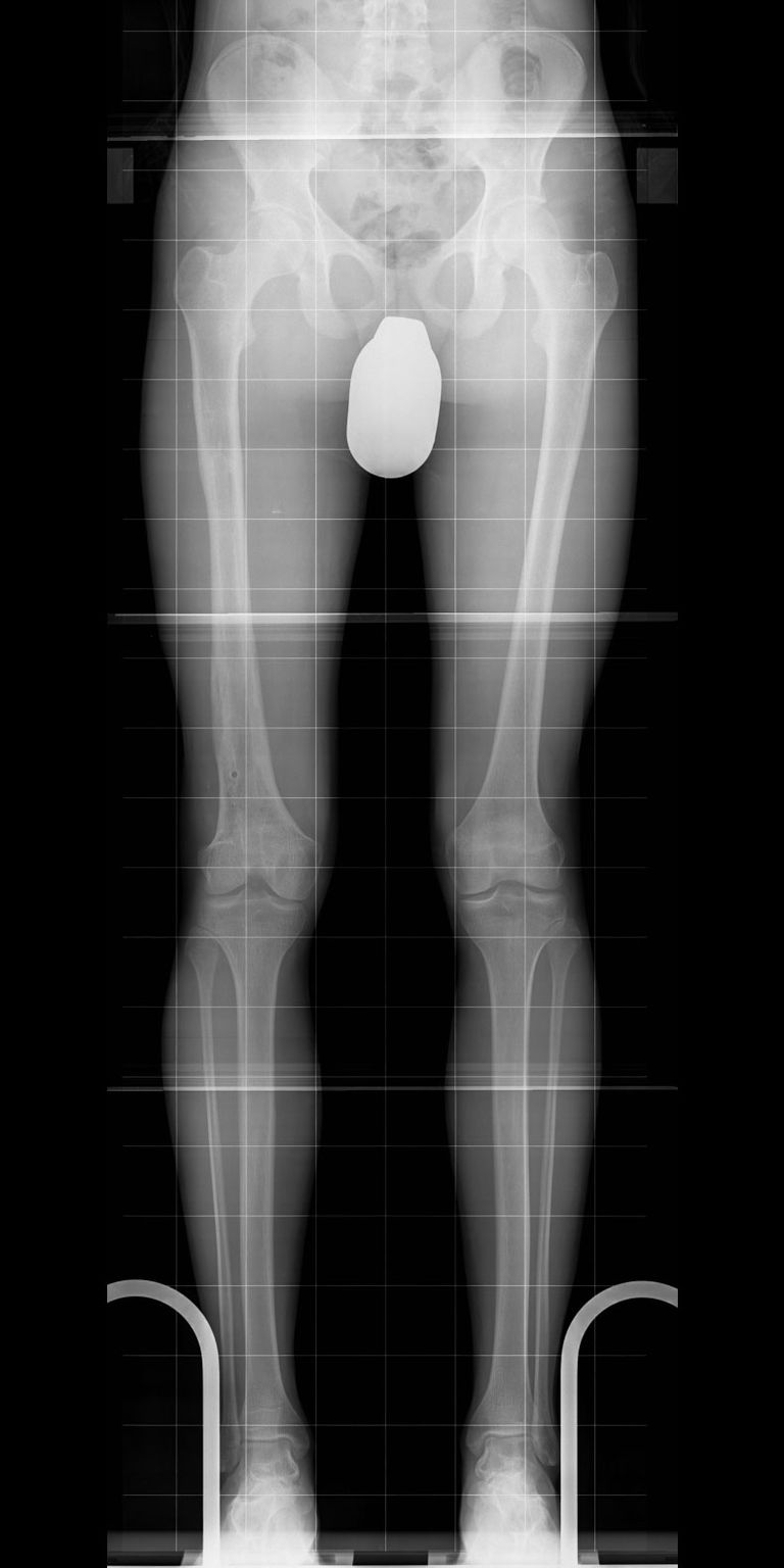 Both legs, straight and of equal length