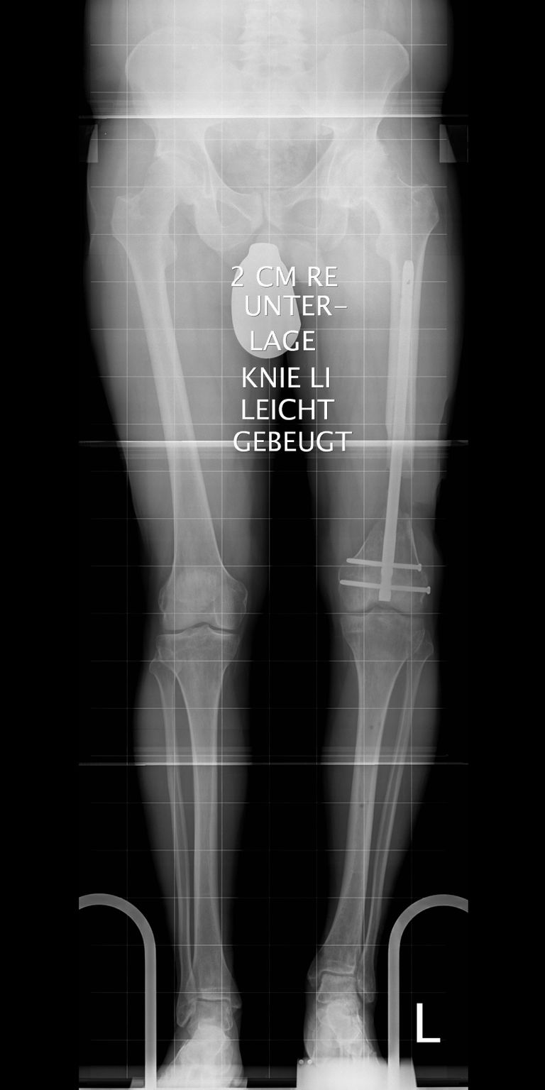 8cm Knochendefekt am linken Oberschenkel