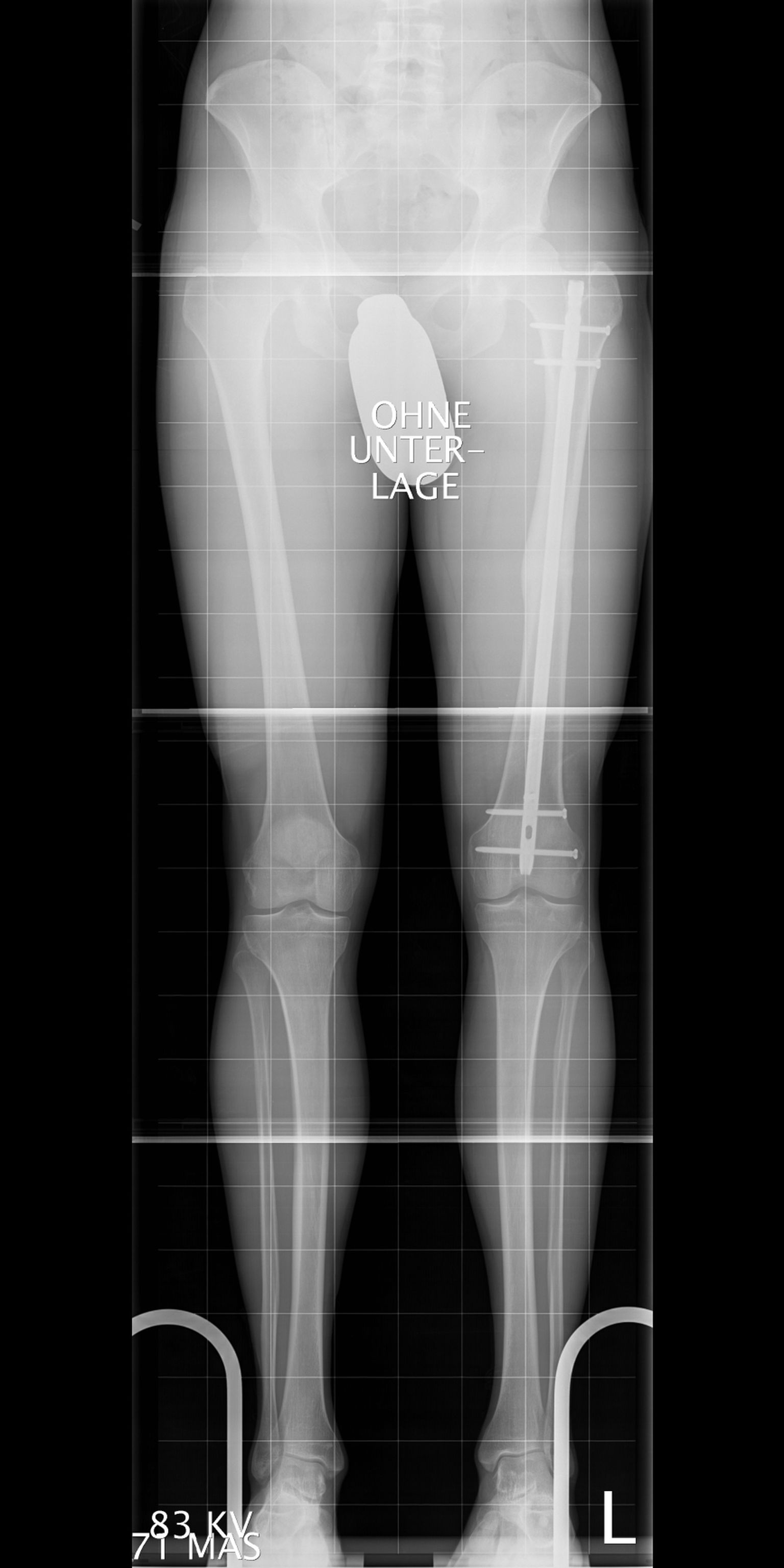 An intramedullary nail stabilizes the surgically shortened bone