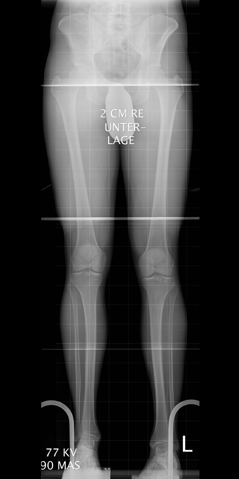 Different knee heights in the X-ray image