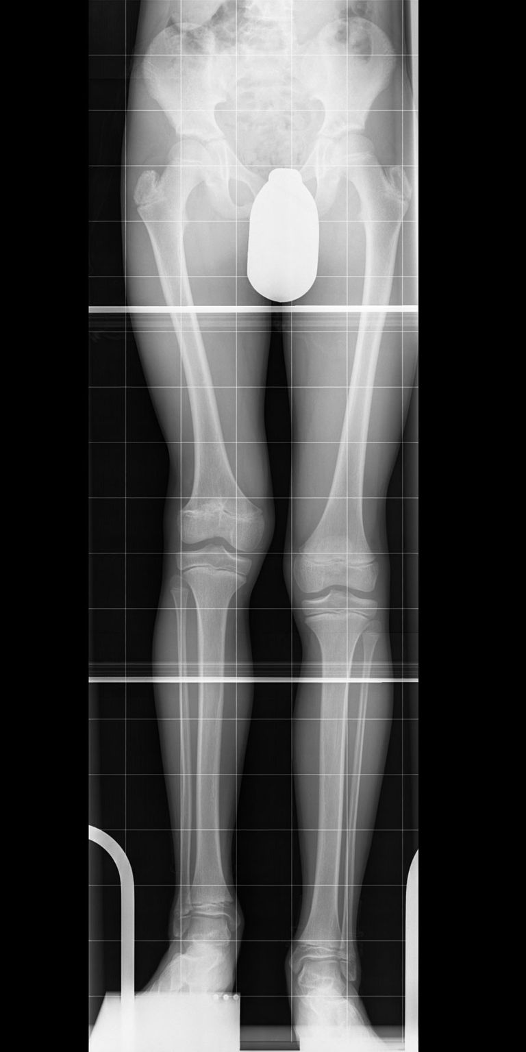 7 cm shortening of the right thigh