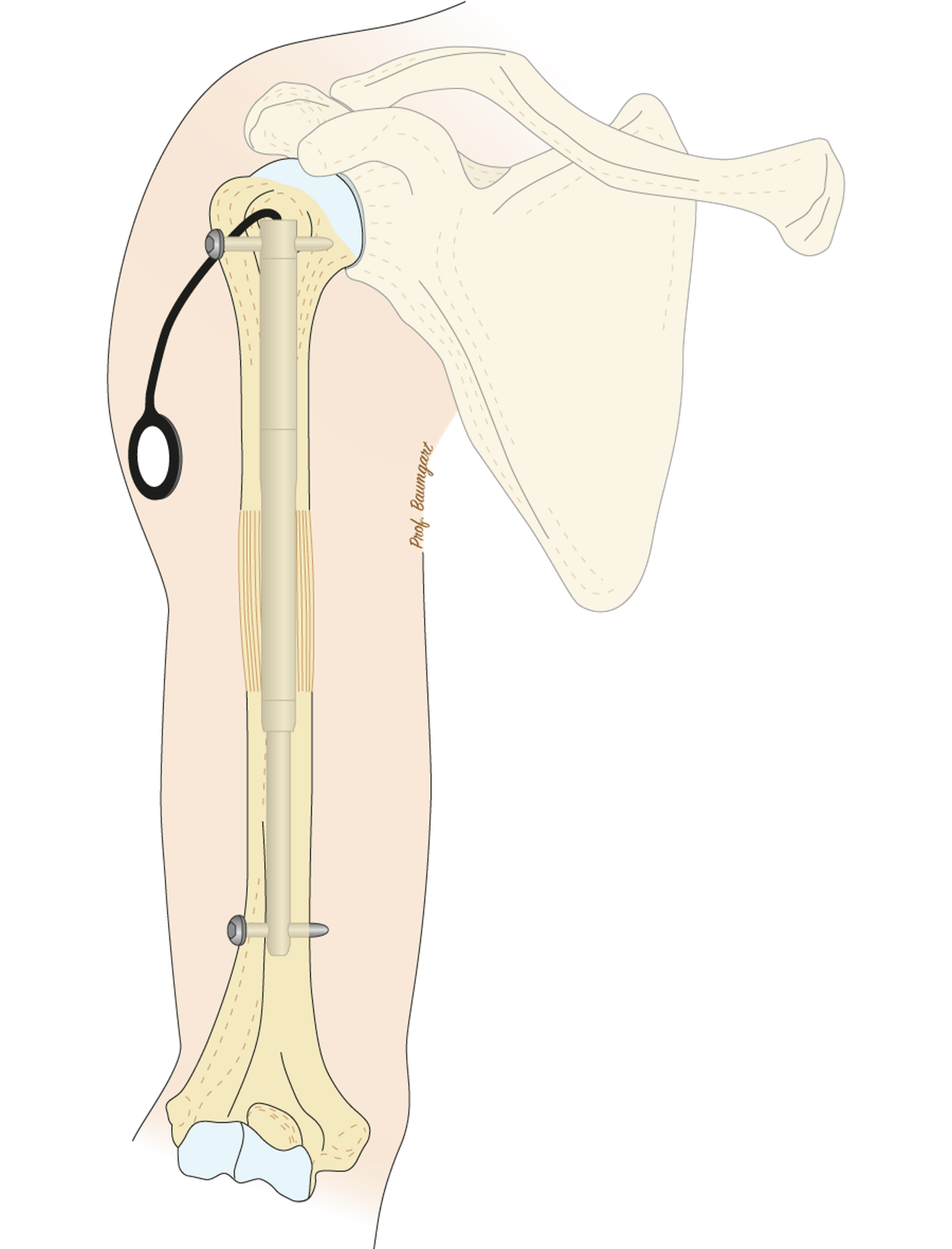 FITBONE im Humerus