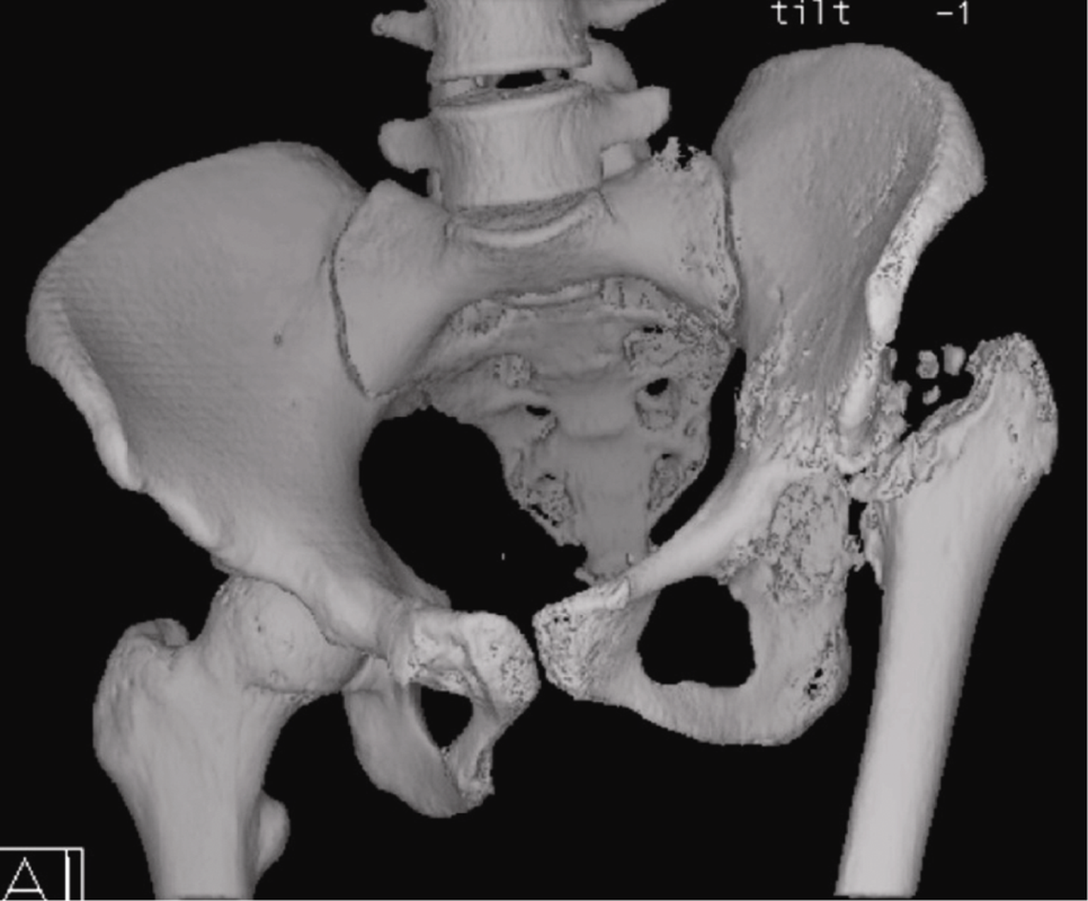Высокий вывих бедра