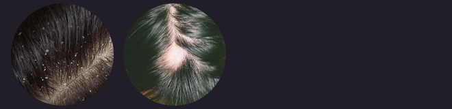 Comparison of a flaky scalp and a healthy scalp showing how SPHINOHANCE® Clear helps reduce dandruff, redness, excess oil, and supports the scalp's natural barrier.