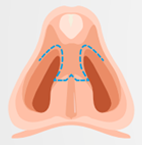 Illustration of an incision for open rhinoplasty, drawing of a nose in front of a grey background.