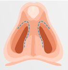 Illustration of an incision for closed rhinoplasty, drawing of a nose in front of a grey background.