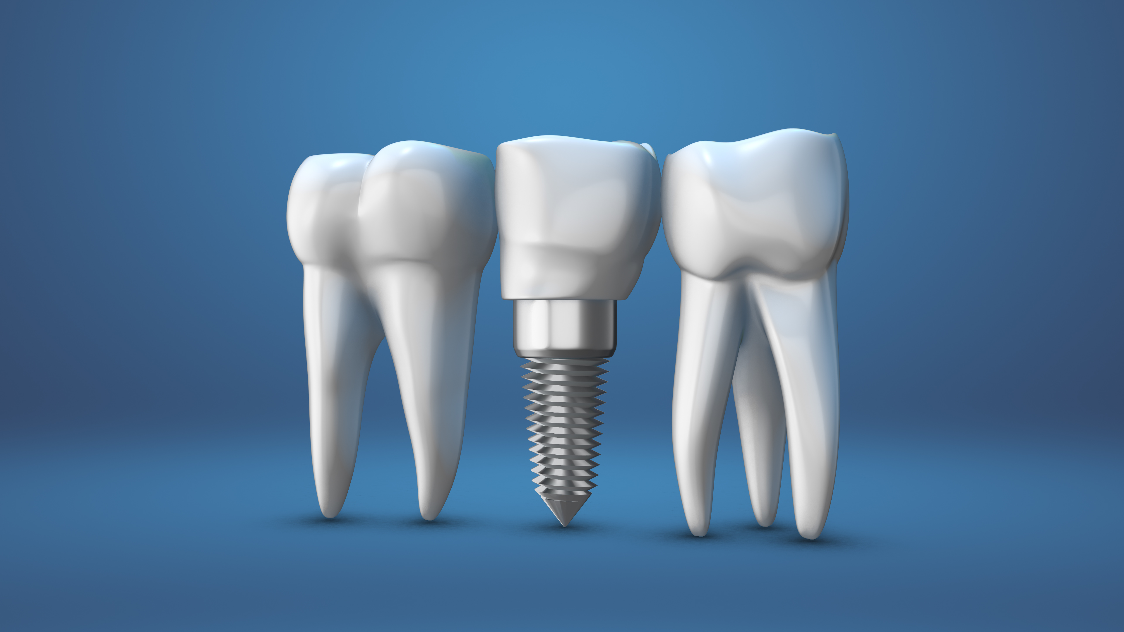 Thinking about dental implants?
