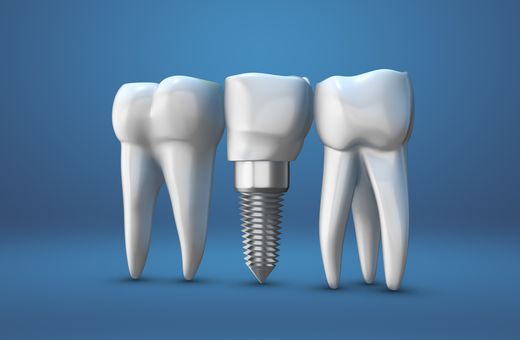Thinking about dental implants? 