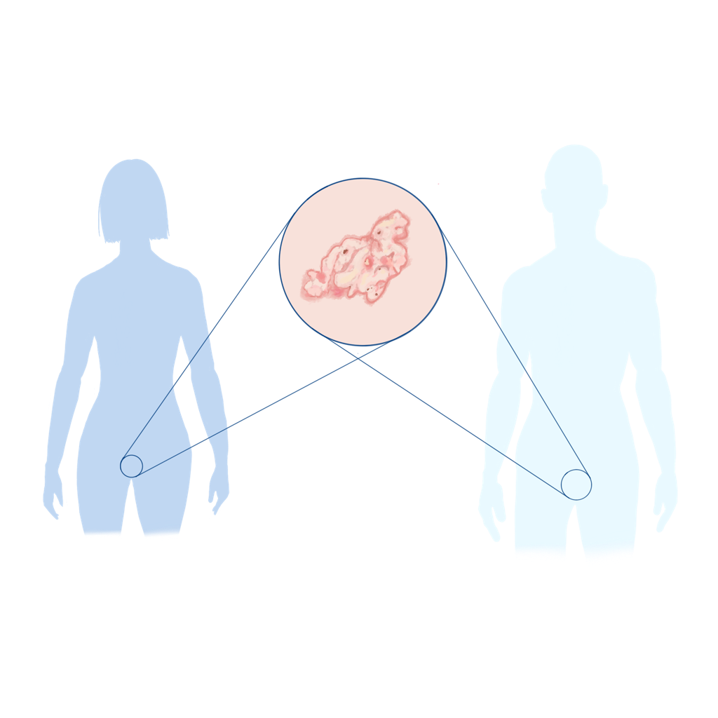 Lichen sclerosis et atrophicans Illustration