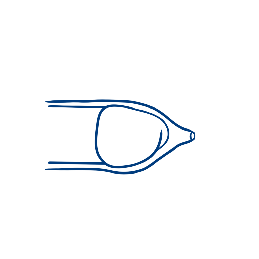 Phimose Illustration