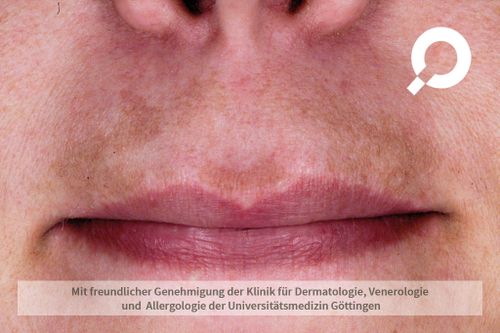 Melasma (Pigmentierungen) - dermanostic