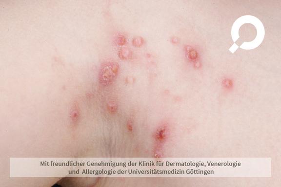 Molluscum contagiosum (Dellwarzen)