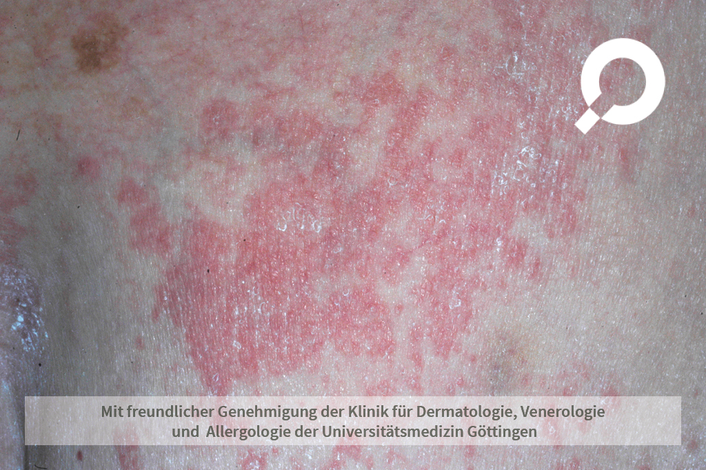 Pityriasis rosea (Röschenflechte) - dermanostic