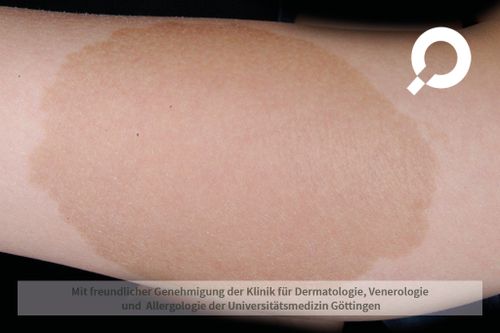 CaféaulaitFlecken dermanostic