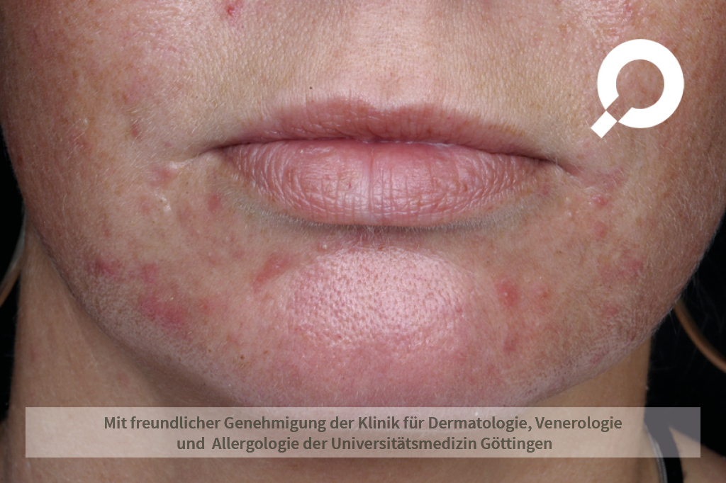 Accutane tabletten kaufen