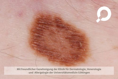 Nävus (Muttermal) dermanostic