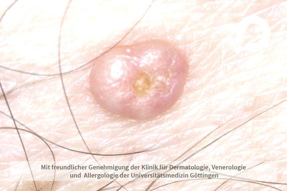 Molluscum contagiosum (Dellwarzen)