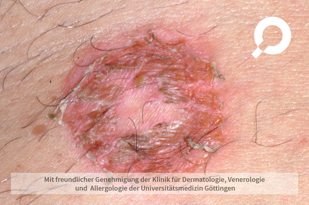 kopfschmerzen von amoxicillin