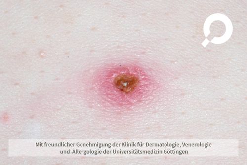 Insektenstiche dermanostic