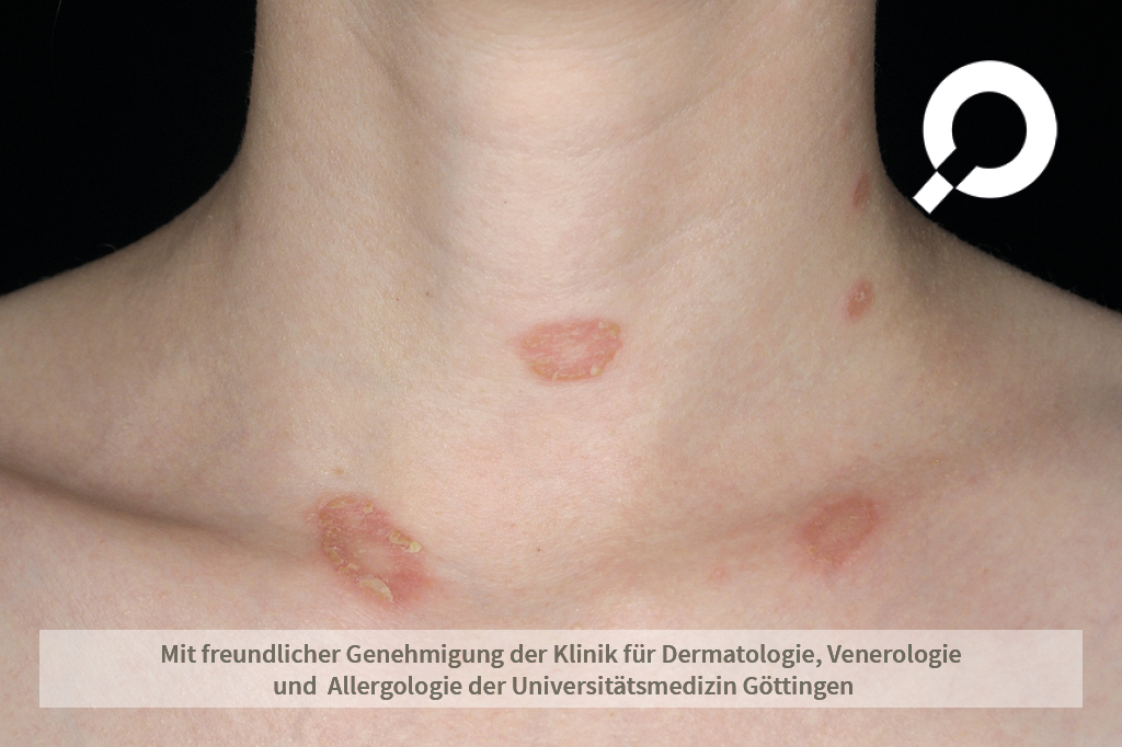 Pilz Unter Der Brust Captions Trend