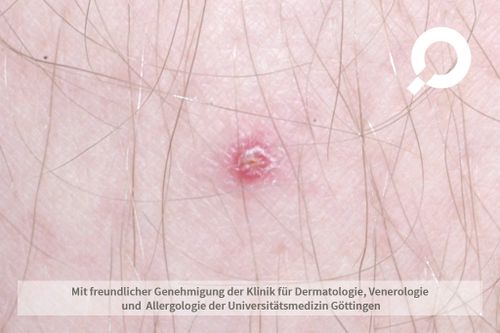 Abszess Nach Injektion Beseitigen – LNJE