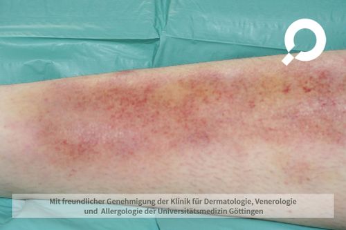 Beispielbild einer Entzündung des Unterhautfettgewebes, Erythema nodosum genannt