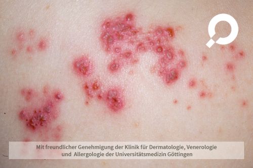 gurtelrose ohne aciclovir