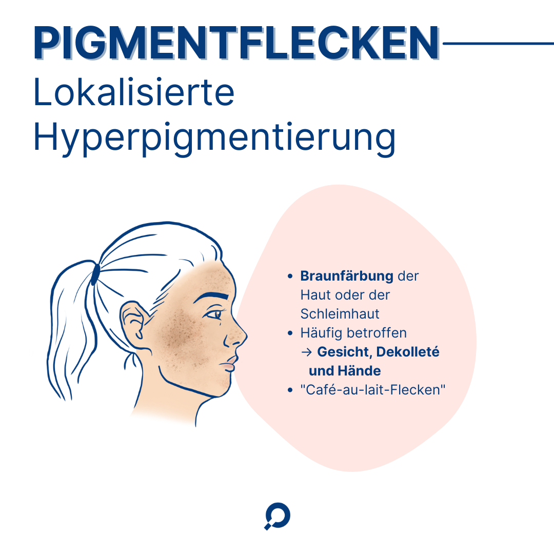 Pigmentflecken Illustration