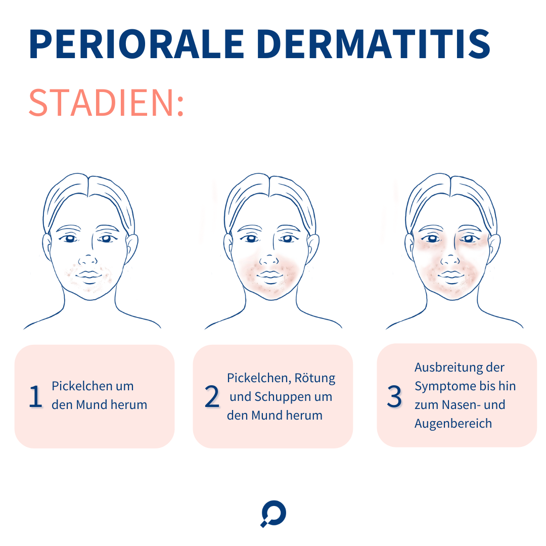 Periorale Dermatitis - dermanostic