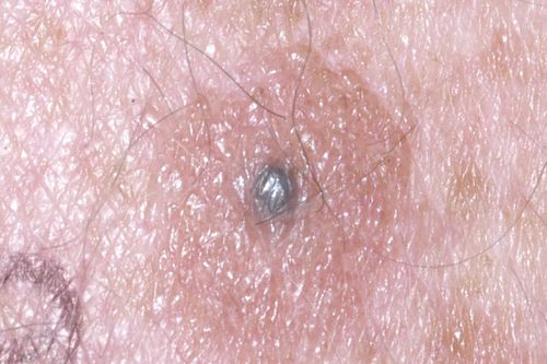 Blaues Muttermal / blauer Nävus (Nävus bleu) - dermanostic