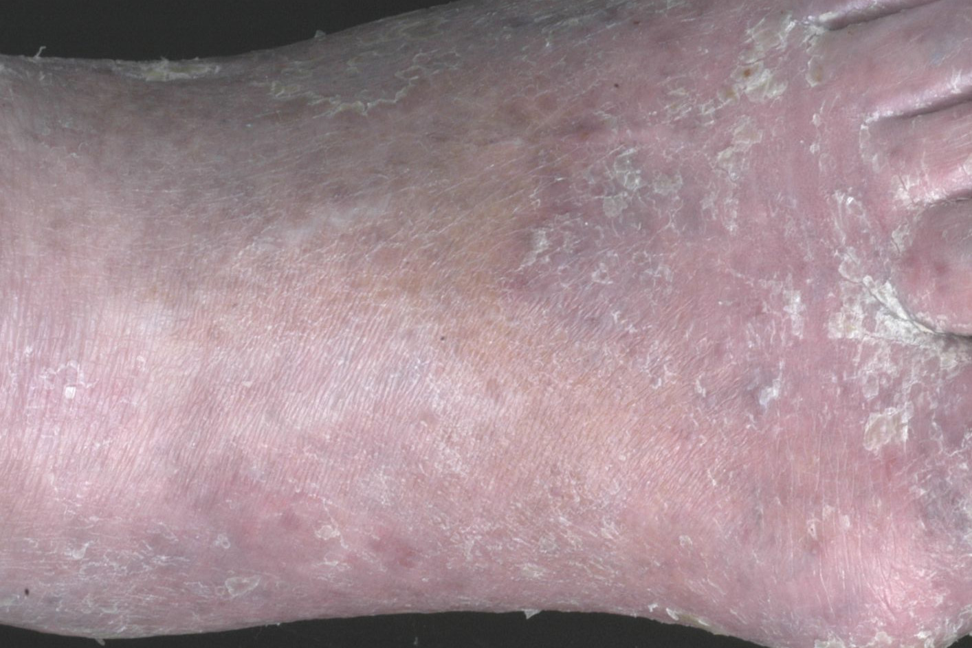 Stauungsdermatitis Anfangsstadium Venöse Insuffizienz Bilder dermanostic.com