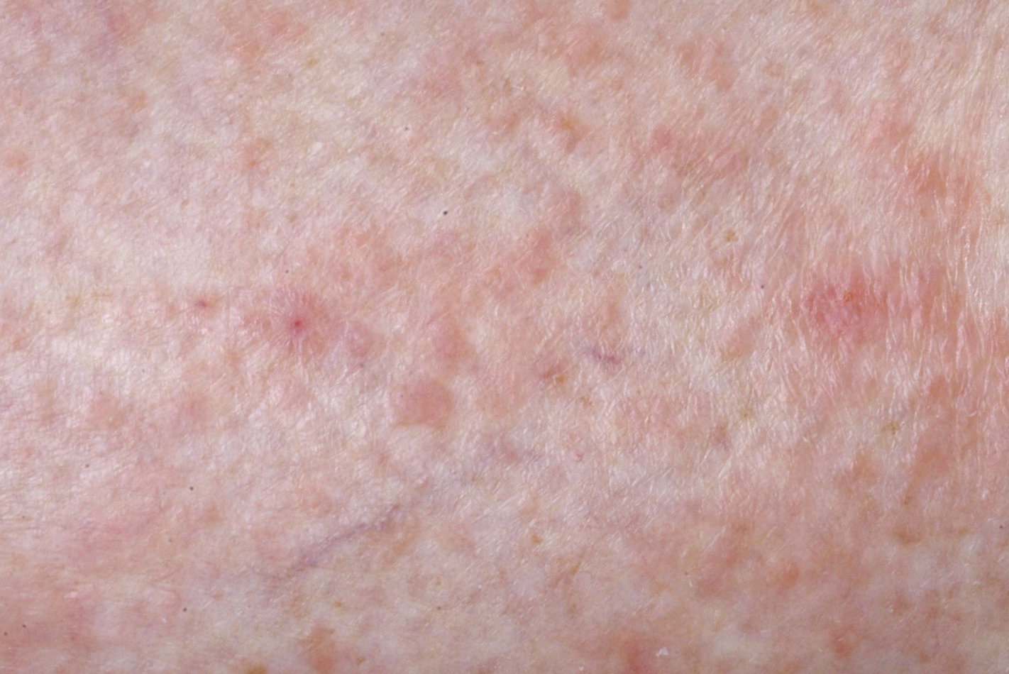 polymorphe-lichtdermatose-sonnenallergie-dermanostic