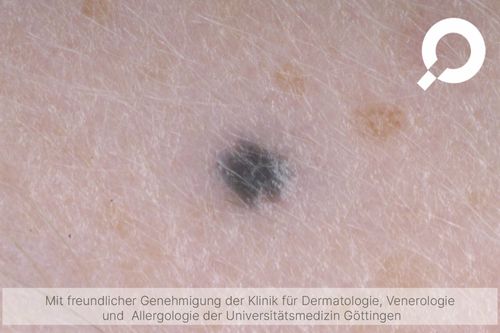 Blaues Muttermal / blauer Nävus (Nävus bleu) - dermanostic