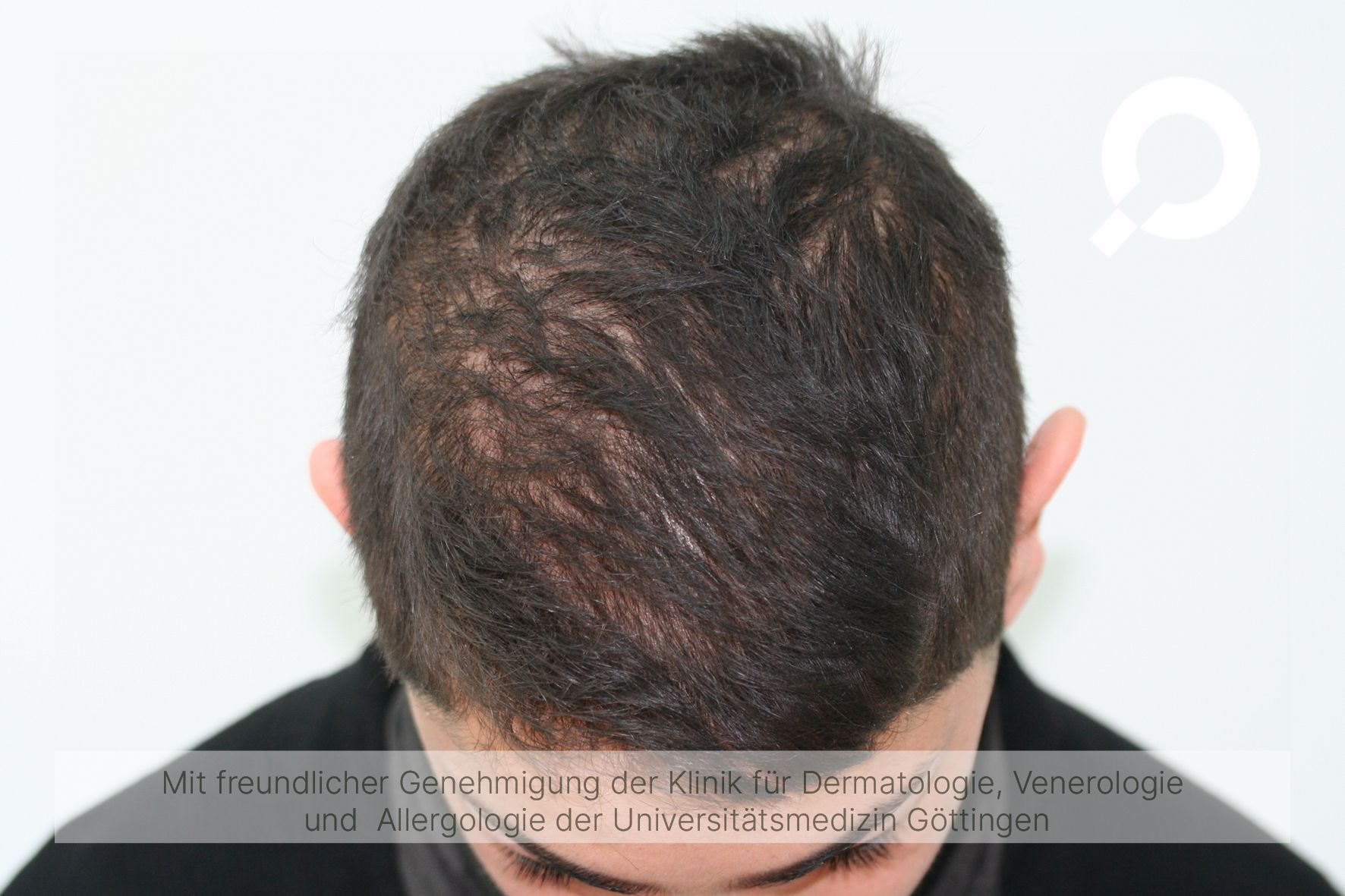 Androgenetische Alopezie Diffuser Haarausfall Frau Verlauf dermanostic.com
