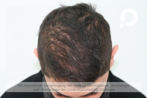 Diffuser Haarausfall (Effluvium) - dermanostic