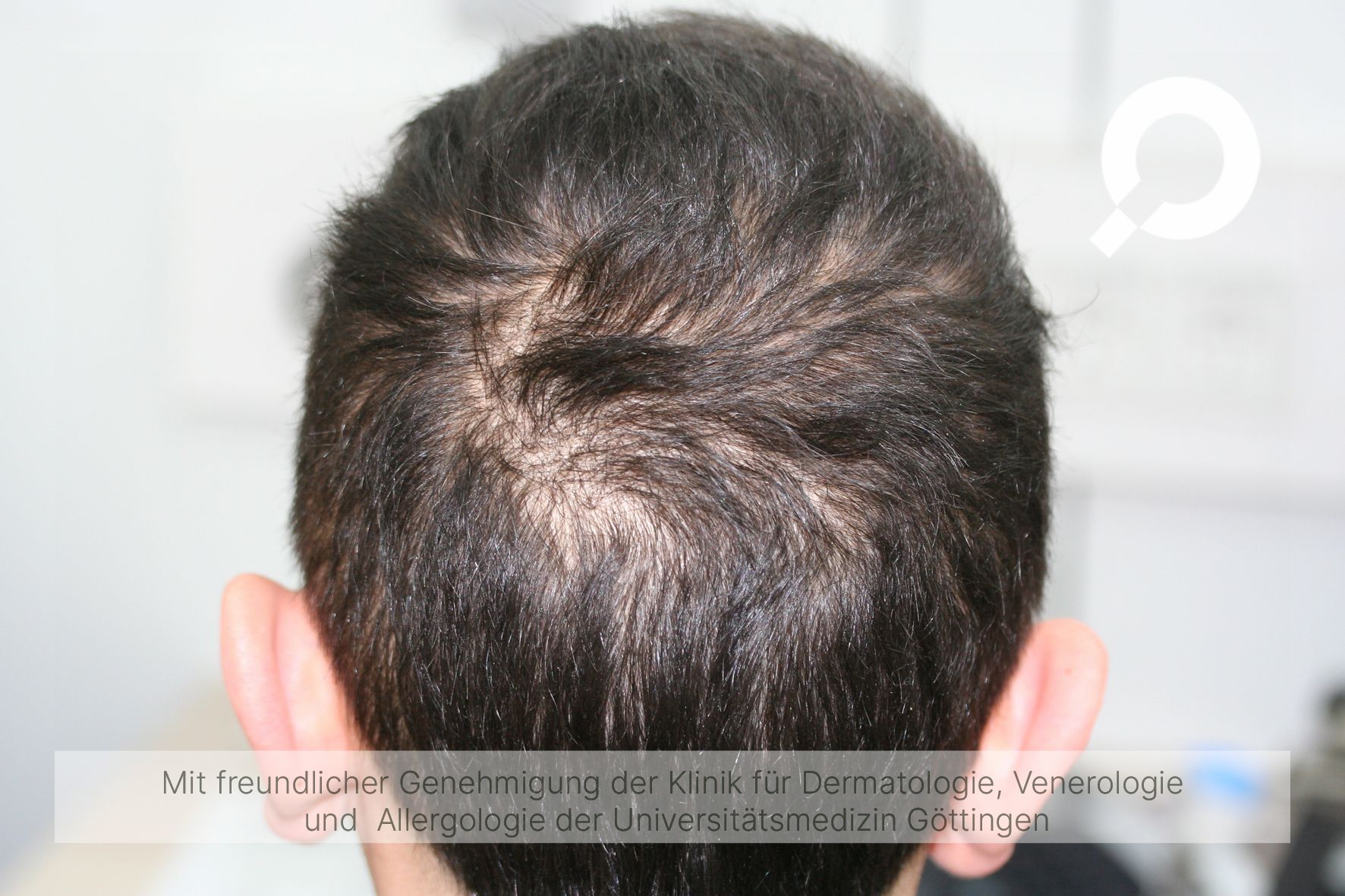 Diffuser Haarausfall (Effluvium) Multiple Ursachen & Behandlung