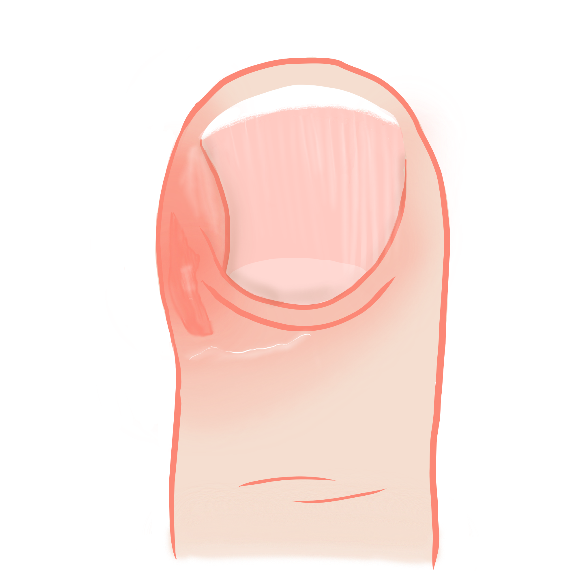 Unguis incarnatus Zeichnung