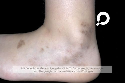 Pigmentflecken Hyperpigmentierung Dermanostic pigmentflecken-hyperpigmentierung-dermanostic