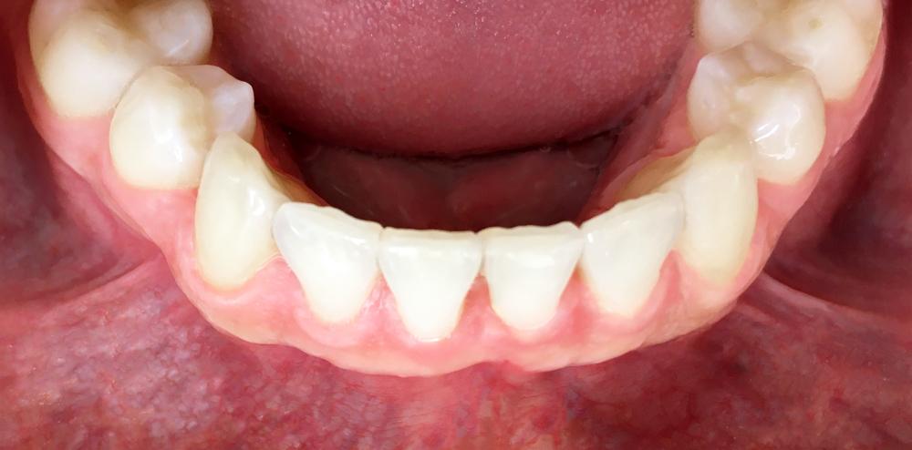 Aligner After