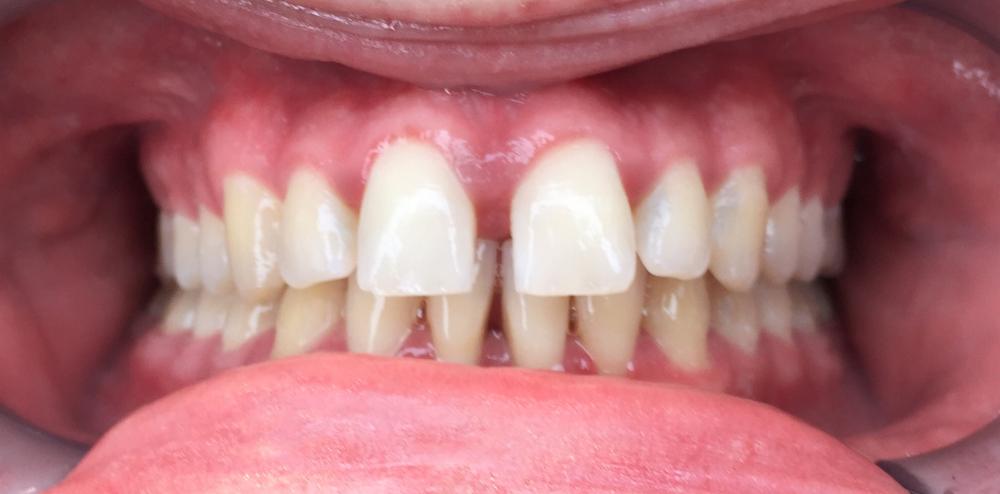 Clear aligners before and after